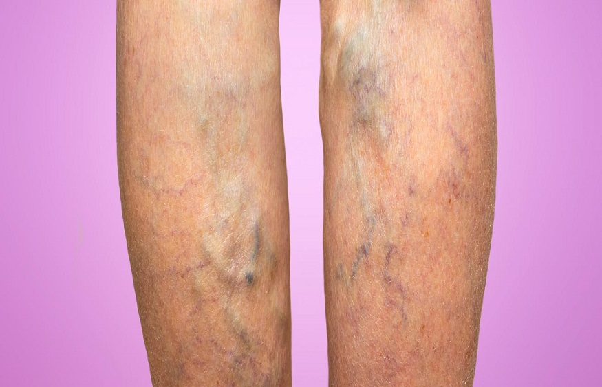 Spider And Varicose Veins