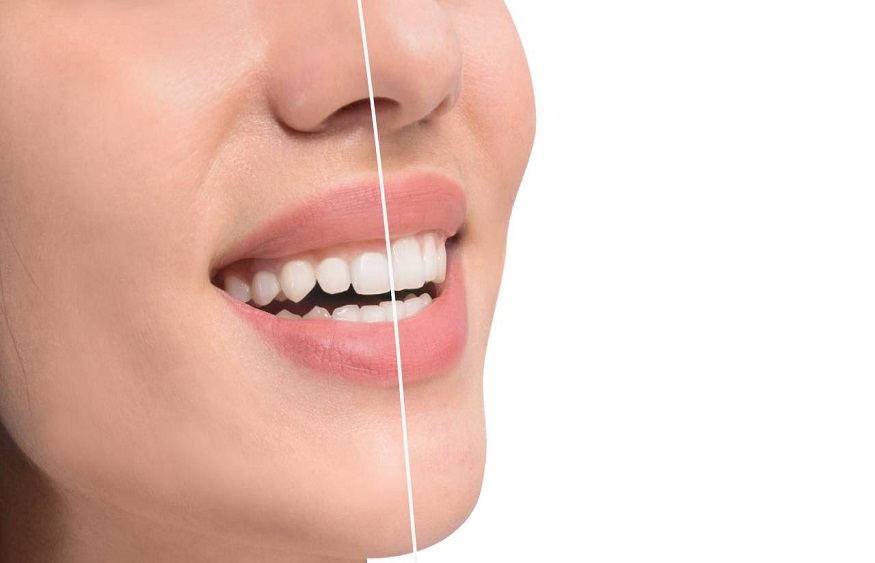 Laser Gum Contouring's Advantages