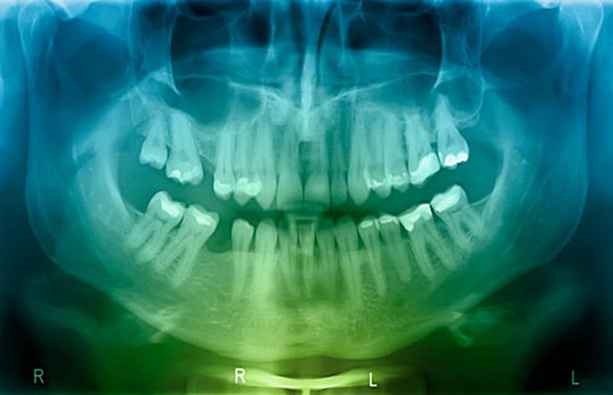 Decoding Dental X-Rays