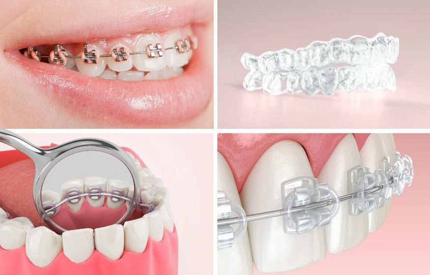 Complex Orthodontic Issues