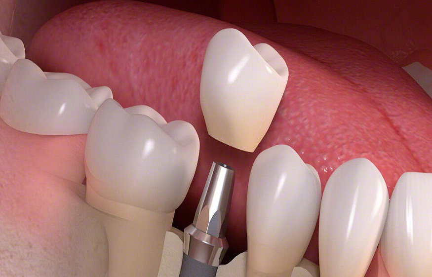 Dental implants in Chelsea