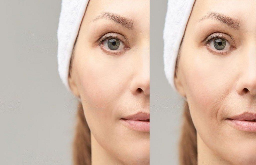 Glutathione IV therapy