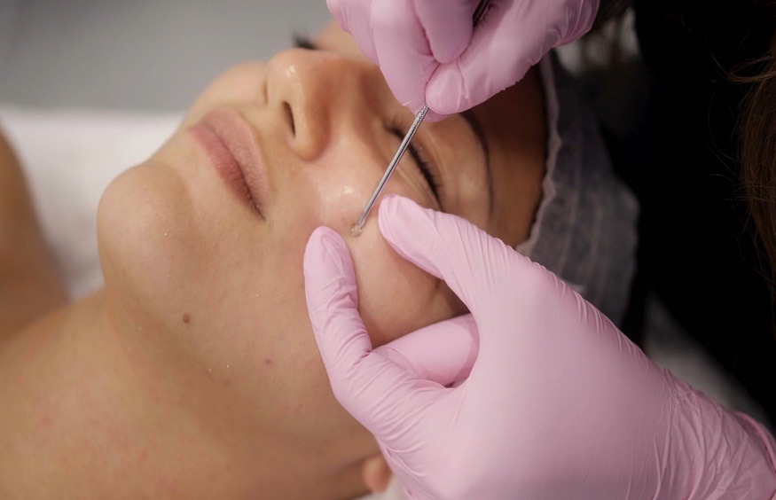 facial extractions